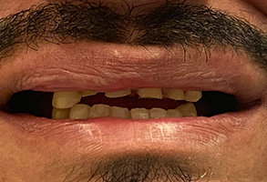 Cosmetic Dentist Denton