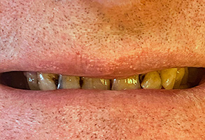 Cosmetic Dentist Denton